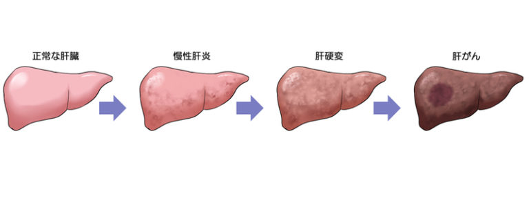 「慢性炎症」肥満と糖化によるリスク
