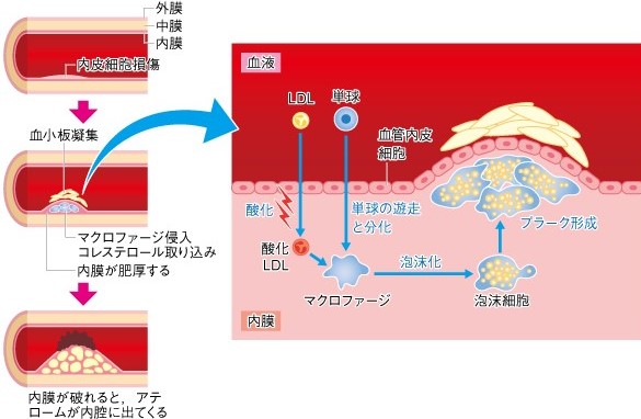 「コレステロールとホルモン合成」動脈硬化は血管の慢性炎症