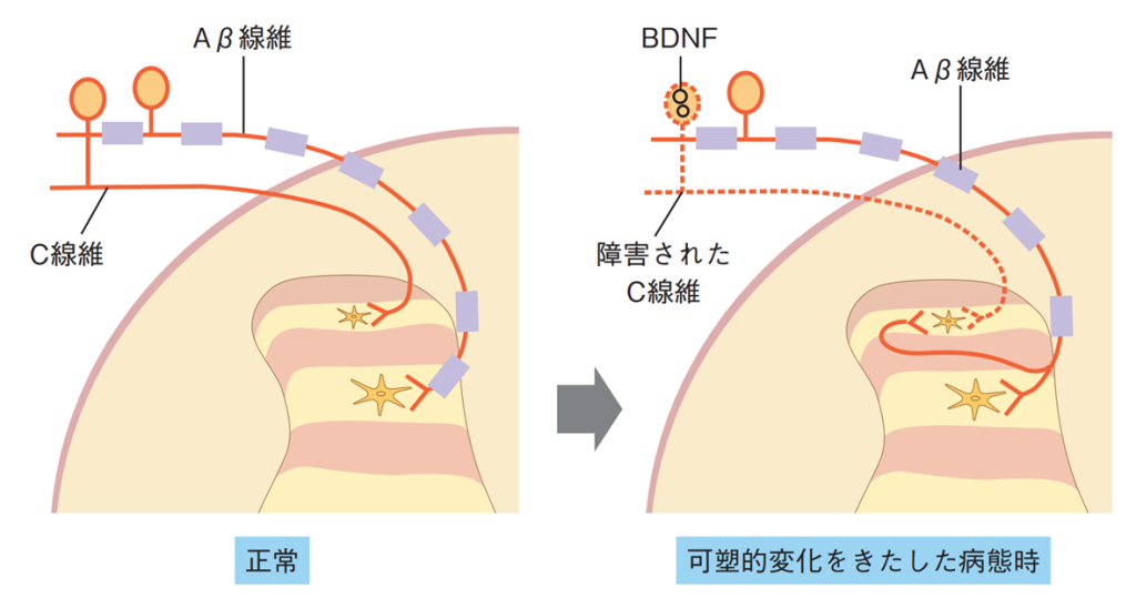 神経のつながり「なぜ痛みが起こるのか？」